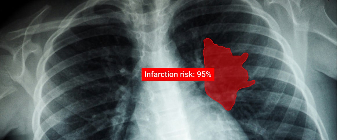 An example of an annotated medical imaging, where the heart is annotated using polygons